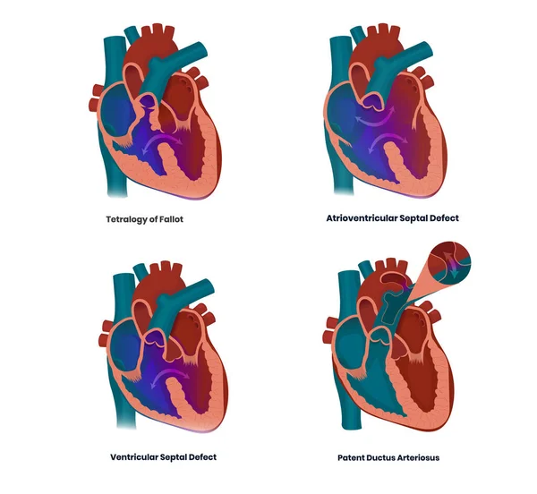Vektorové Ilustrace Srdečních Vad Spojených Downovým Syndromem Vektrikulární Arterioventrikulární Vady — Stockový vektor