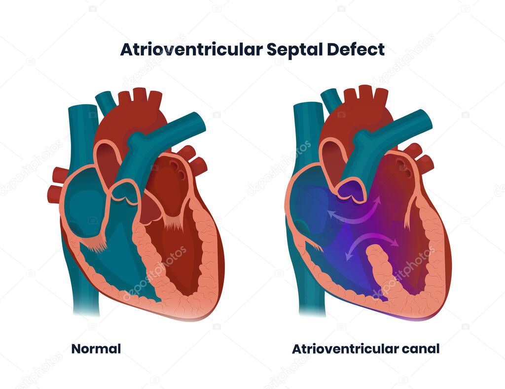 Atrioventricular septal defect. Illustration of the congenital heart defect of the wall separating left and right atria and ventricules