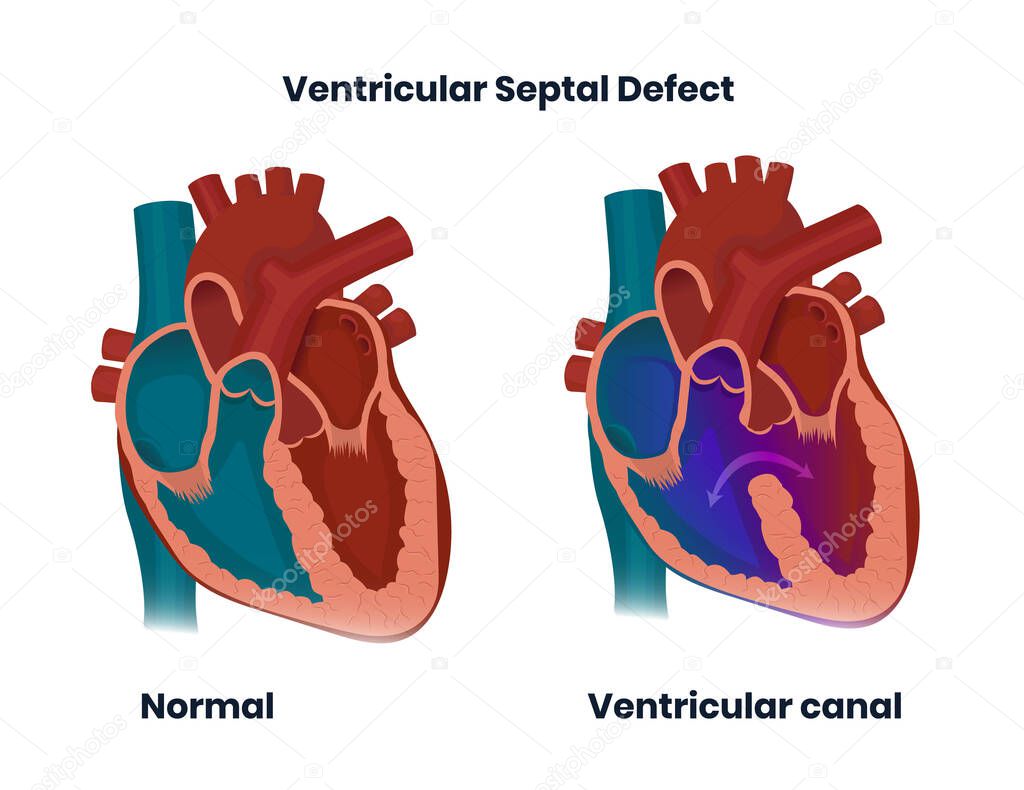 Ventricular septal defect with normal heart anatomy. Illustration of  the congenital defect of the ventricular wall