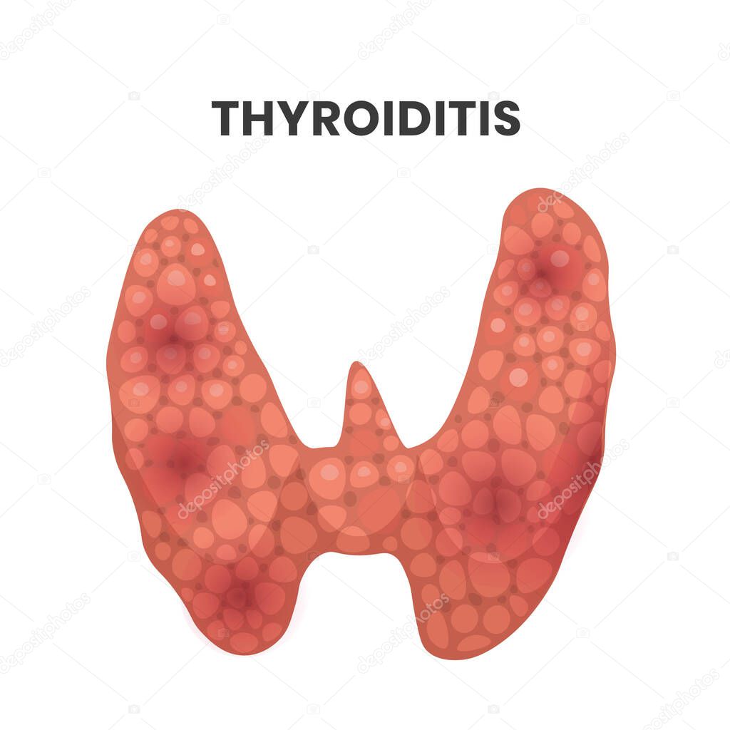 Thyroiditis illustration. vector illustration of the thyroid gland disease