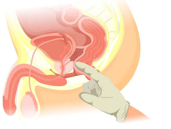 Dijital rektal muayene vektör çizimi. Kafkas erkeğinin prostatını inceleyen parmağın resmi.