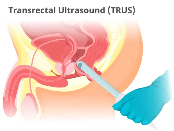 Ilustracja Trus Przezodbytnicze Badanie Ultrasonograficzne Prostaty Ilustracja Dłoni Trzymającej Usg — Wektor stockowy