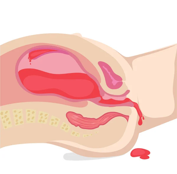 Ilustração Sangramento Durante Gravidez Hemorragia Pós Parto Sangue Está Saindo —  Vetores de Stock