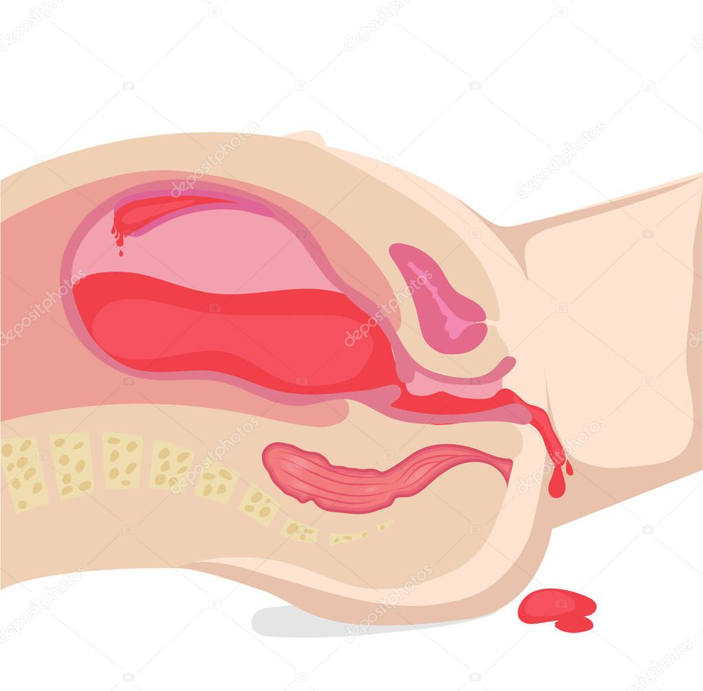 Illustration of the bleeding during pregnancy. Postapartum hemorrhage - blood is coming out of the womb
