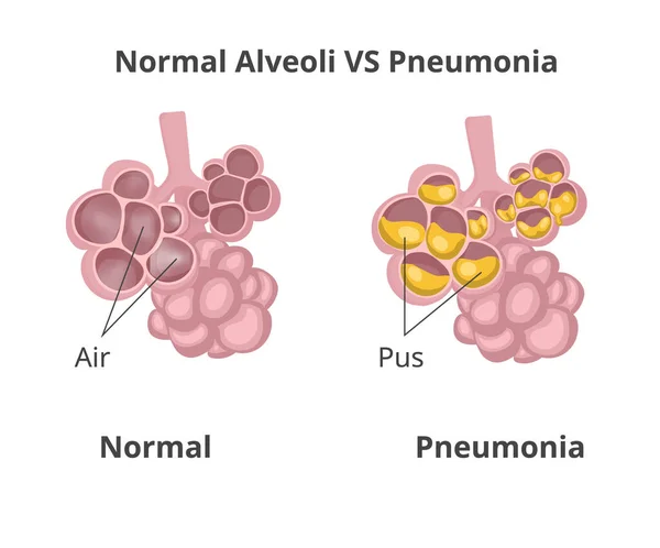 Illustrazione Dei Normali Alveoli Aerati Alveoli Polmonite Con Pus — Vettoriale Stock