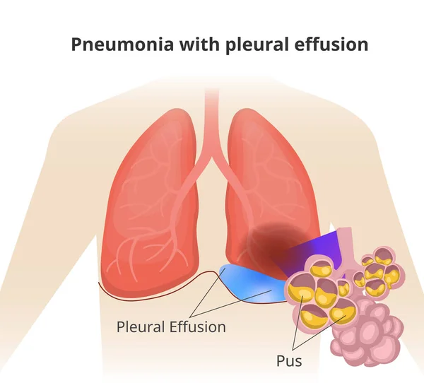 Illustration Des Poumons Avec Pneuomonie Épanchement Pleural Gros Plan Sur — Image vectorielle