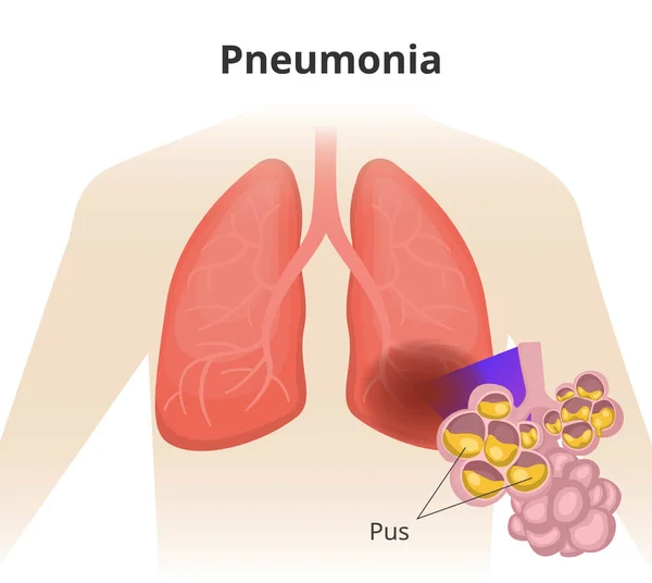 Illustration Human Lungs Left Lung Affected Pneumonia Close Alveoli Pus — Stock Vector