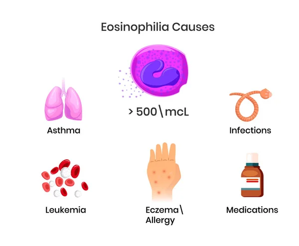 Причины Эозинофилии Диаграмма Показывает Астму Аллергию Паразитарную Инфекцию Вызывающую Повышение — стоковый вектор