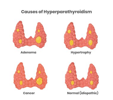 Hyperparathyroidism causes illustration. Adenoma, cancer, enlargement, and normal parathyroid glands vector clipart