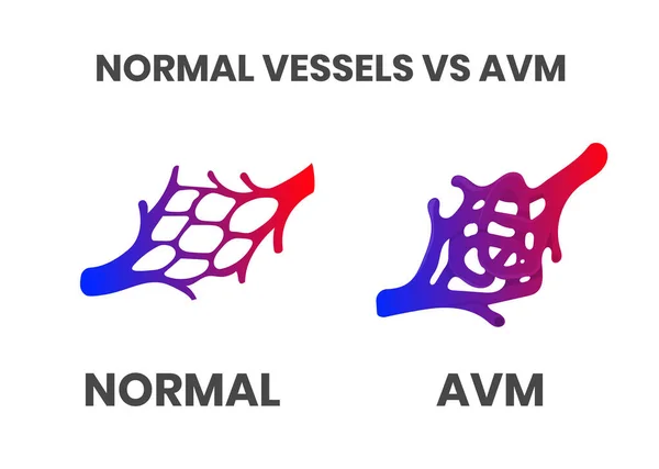 Normal Vessels Arteriovenous Malformation Avm Vector Illustration — Stock Vector
