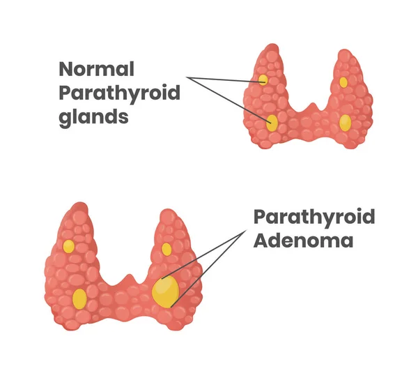 Normal Parathyroid Glands Parathyroid Adenoma Comparison Vector Illustration — Stock Vector