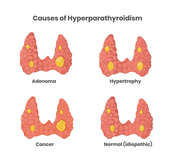 Hyperparathyroidism Causes Illustration Adenoma Cancer Enlargement Normal Parathyroid Glands Vector — Stock Vector