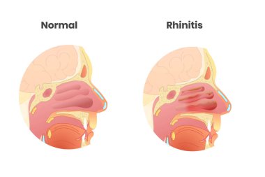Normal burun boşluğuna karşı rhinitis antomi çizimi