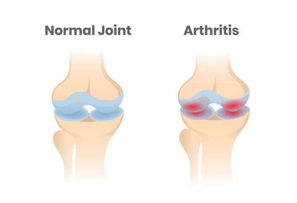 Normal joint versus  Arthritis. Knee inflamation scientific illustration