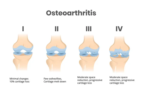 Osteoartritida Kolenního Kloubu Čtyři Fáze Anatomické Vědecké Vektorové Ilustrace — Stockový vektor