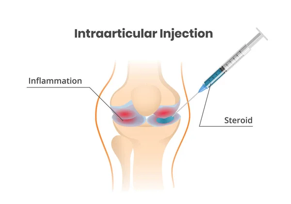 Knee Joint Injection Injection Corticosteroids Scientific Vector Illustration — Stock Vector