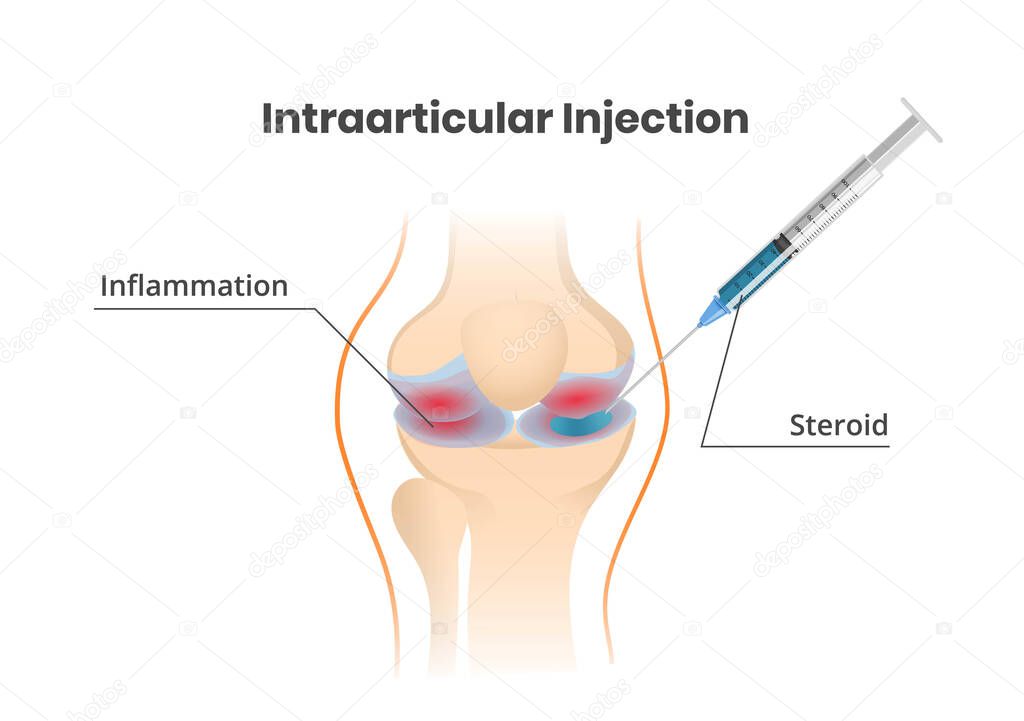 Knee joint injection. Injection of the corticosteroids scientific vector illustration