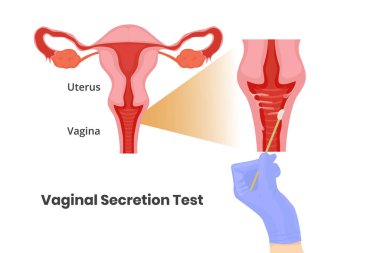 Vaginal secretion test. Doctor's hand in the glove is taking a swab from vaginal wall clipart