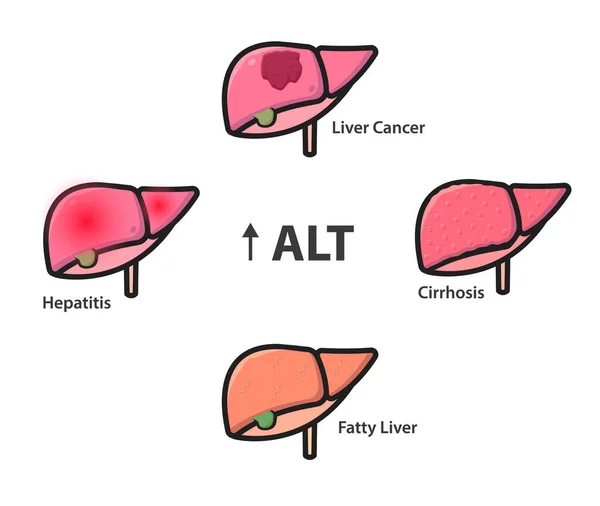 Condiciones Hepáticas Con Alto Nivel Alt Una Ilustración Vectores Sanguíneos — Vector de stock