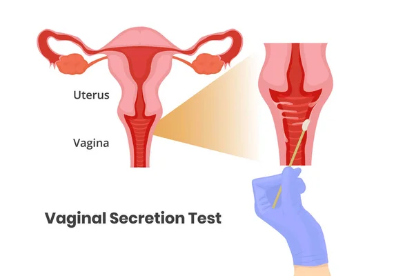 Teste Secreção Vaginal Mão Médico Luva Está Tirar Cotonete Parede —  Vetores de Stock