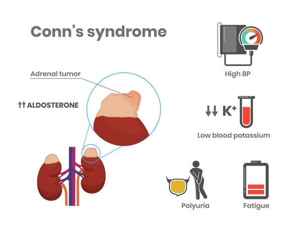 Conn Szindróma Okai Tünetei Illusztráció Elsődleges Aldoszteronizmus Tudományos Orvosi Illusztráció — Stock Vector