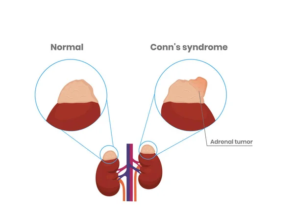 Adrenal Körtel Normal Anatomi Och Binjurebarksadenom Vektor Vetenskaplig Illustration — Stock vektor