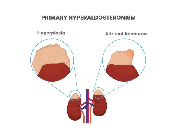 Primair Aldosteronisme Bijniertumor Hyperplasie Oorzaken Van Hoog Aldosteron — Stockvector