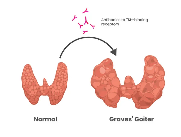 Graves Krankheit Verursacht Tsh Rezeptor Antikörper — Stockvektor