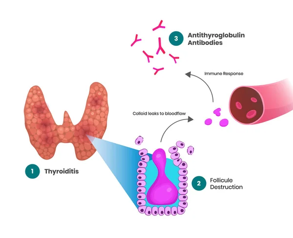 Physiologie Des Anticorps Thyroglobuline — Image vectorielle