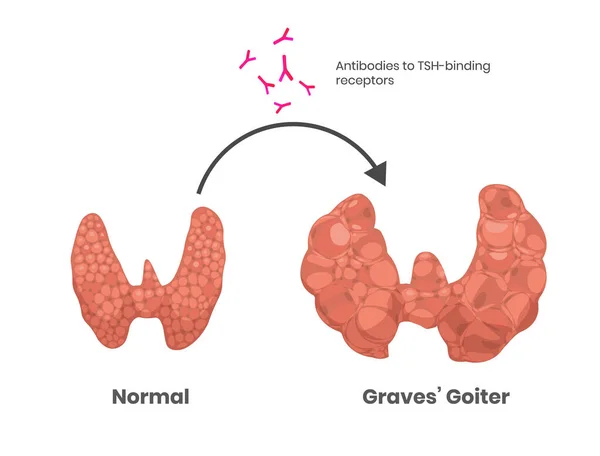 Grave Disease Cause Tsh Receptor Antibodies — Stock Vector