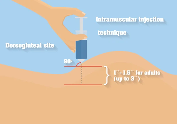 Técnica de injeção intramuscular ilustração vetorial. Ângulo e profundidade do procedimento médico intramuscular . — Vetor de Stock