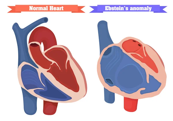 Ebstein anomaly versus nirmal heart structure vector illustration. — Stock Vector