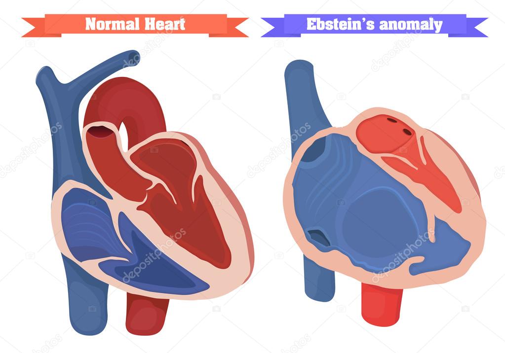 Ebstein anomaly versus nirmal heart structure vector illustration.
