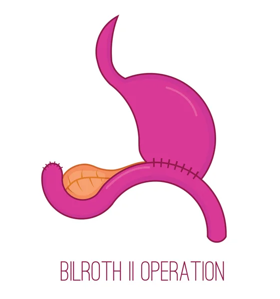 Bilroth 2 operace ilustrace. Gastroenterostomy vektorové ikony. — Stockový vektor