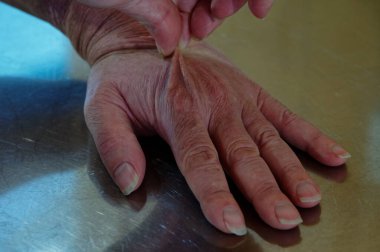 Paslanmaz çelik bir bankta susuzluk testi için elin arkasını çimdiklemek.