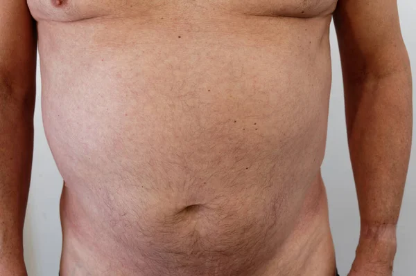 男性胸部和腹部周围的脂肪沉积 — 图库照片