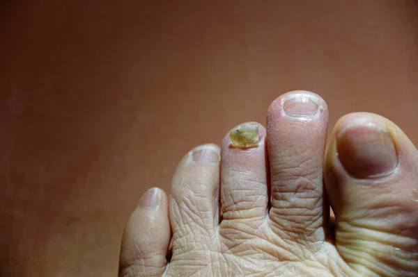 Ayak tırnağı söküldükten sonra ilk yardıma ihtiyacı varmış gibi görünüyor.