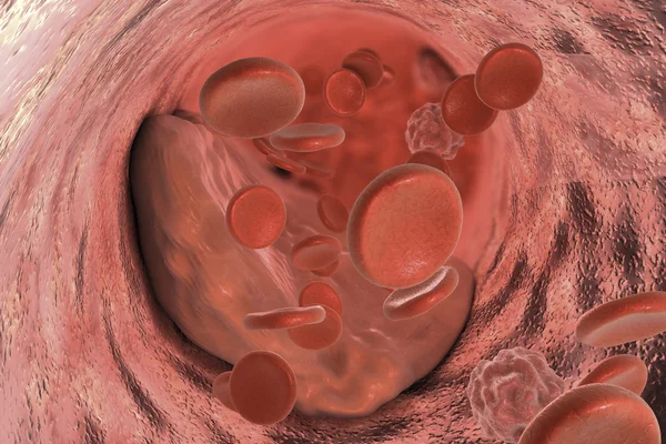 동맥 내 플 라크 atheroma — 스톡 사진