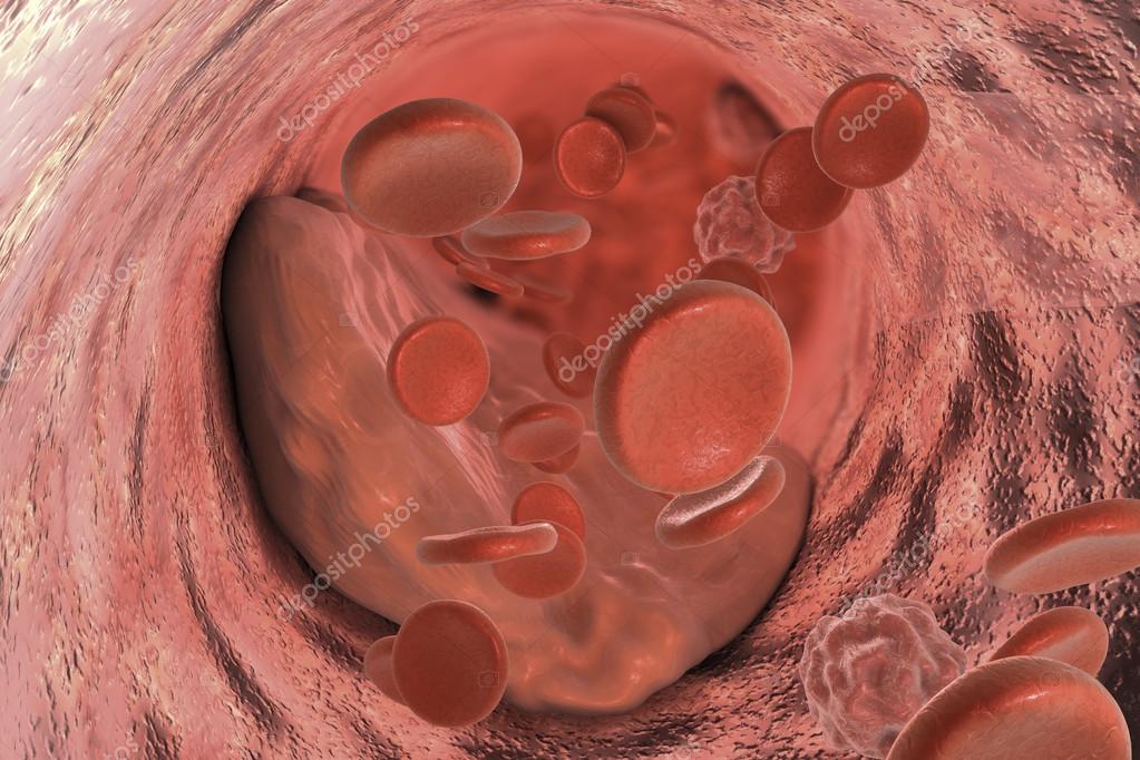 Atheroma plaque inside artery Stock Photo by ©katerynakon 121567194