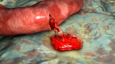 Hemorrhage, blood flowing from the damaged blood vessel, 3D illustration. Hemorrhagic stroke, traumatic injury or other diseases with bleeding