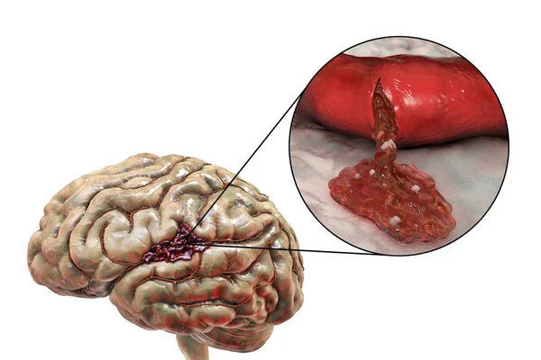 Hemorrhagic Stroke Illustration Showing Hemorrhage Brain Surface Closeup View Bleeding — Foto de Stock