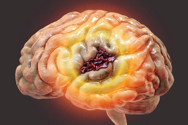 Acv Hemorrágico Ilustración Hemorragia Superficie Del Cerebro Sangrado Vaso Sanguíneo —  Fotos de Stock
