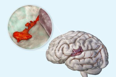 Hemorrhagic stroke, 3D illustration showing hemorrhage on the brain surface and closeup view of the bleeding from a brain blood vessel
