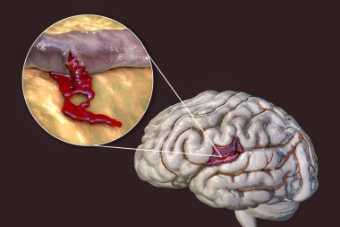 Hemorrhagic stroke, 3D illustration showing hemorrhage on the brain surface and closeup view of the bleeding from a brain blood vessel