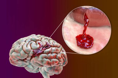 Hemorrhagic stroke, 3D illustration showing hemorrhage on the brain surface and closeup view of the bleeding from a brain blood vessel