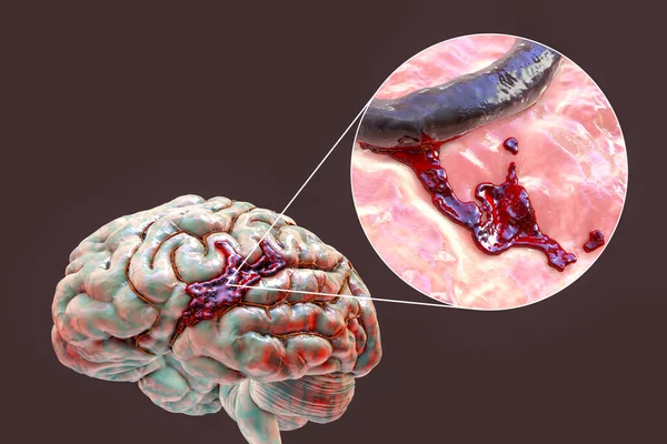 Hemorrhagic Stroke Illustration Showing Hemorrhage Brain Surface Closeup View Bleeding — Stock fotografie