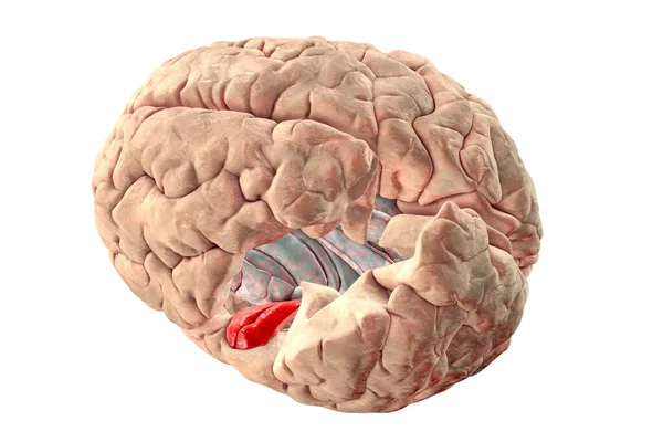 Human Brain Highlighted Red Transverse Temporal Gyri Which Part Primary — Foto de Stock