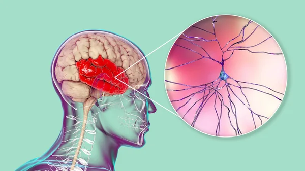 側頭葉に焦点を当てたヒトの脳と側頭葉に見られる錐体神経細胞のクローズアップ 3Dイラスト — ストック写真
