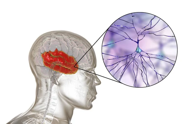 Cerebro Humano Con Lóbulo Temporal Resaltado Vista Cerca Las Neuronas — Foto de Stock