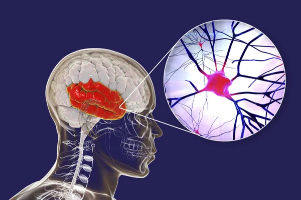 Cerebro Humano Con Lóbulo Temporal Resaltado Vista Cerca Las Neuronas —  Fotos de Stock
